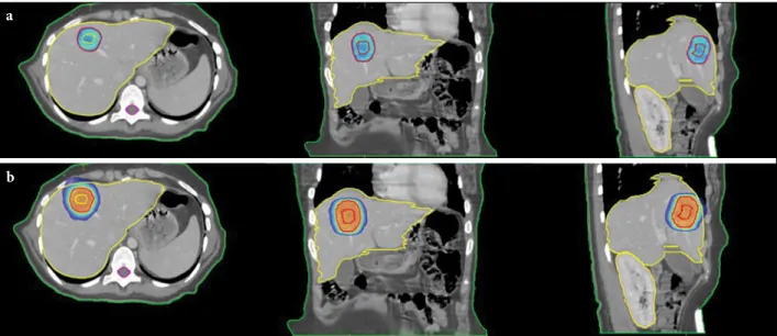 Fig. 2.  The images of a representative patient at axial, coronal, and sagittal images demonstrating (A) 95% and (B) 50% of 