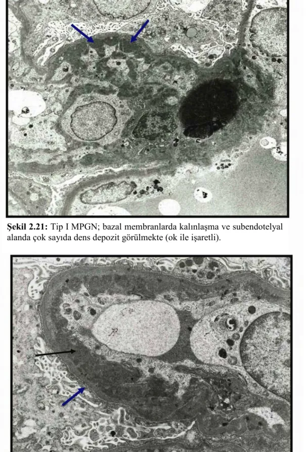 Şekil 2.21: Tip I MPGN; bazal membranlarda kalınlaşma ve subendotelyal 