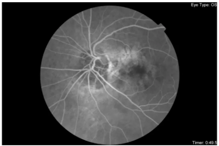 Figure 1. Fundus colour photo of the left eye: Tilted optic disc with the inferionasal pseudodublicated disc.