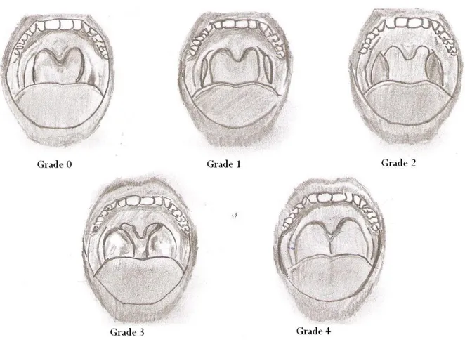 ġekil 2. Freidmanın sınıflamasına göre tonsil gradeleme sistemi çizimi. 