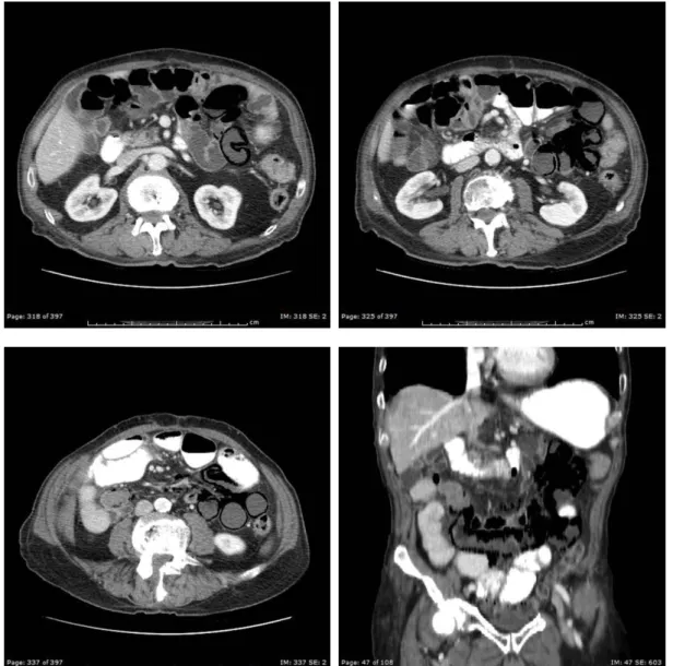 Figure 1-4. Abdominal CT shows dilatation of  small bowel loops and the air bubbles in the wall of small  bowels, in addition to extensive air bubbles between the leaves of mesenteric 