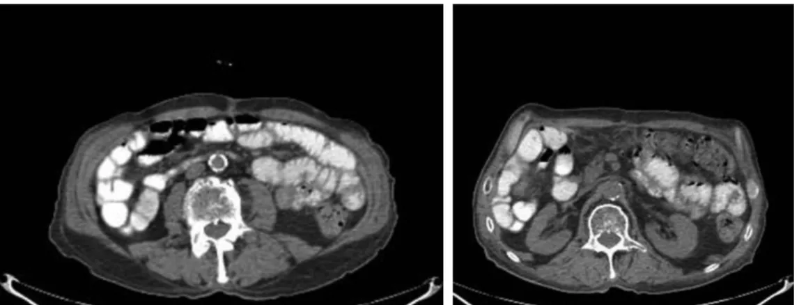 Figure 5-6. Second abdominal CT shows normal findings, emergency radiologic findings are disappeared