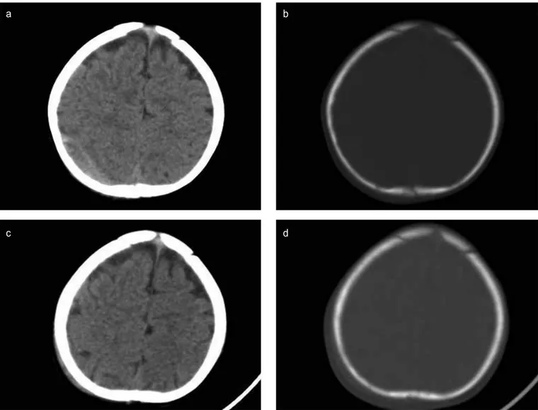 FIG. 1. a-d. Axial computerized tomography revealed that epidural hematoma at the right parietal region (a), right parietal fracture at the bone window (b),  and axial brain computerized tomography demonstrated that the complete resolution of epidural hema