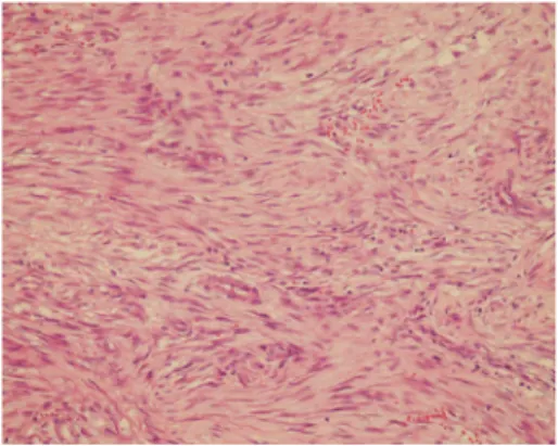 Figure 1: Picture shows that spindle cell proliferation admixed with inflammatory cells (HE ×40).