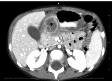 Figure 1. The initial computed tomography image: A cystic lesion  (asterisk) measuring 30×28 mm at the gastric antrum