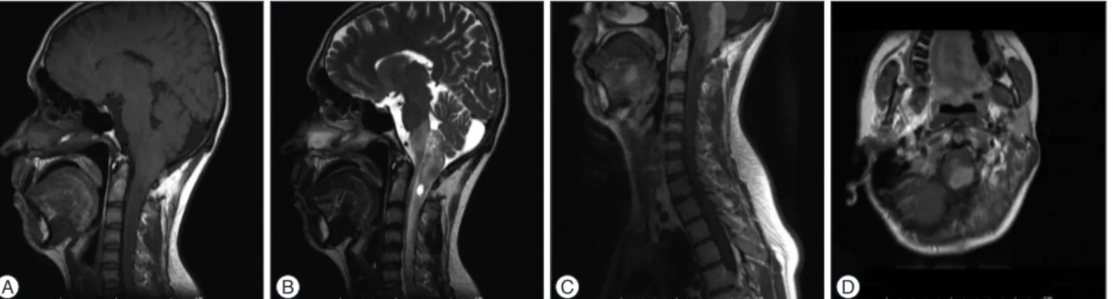 Fig. 1. Diffuse cord edema extending from medulla oblongata to C6 level and cystic component are seen on sagittal T1 (A) and T2 (B) weighted MR  images
