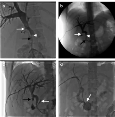 FIG. 1. a, b. Cholangiography film obtained after the internal-external 