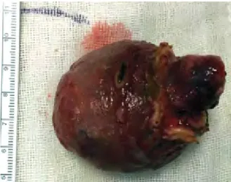 Figure 3. Laparoscopic wedge resection was performed for the complete  removal of the giant polyp (7.5×6.5×5.5 cm at the macroscopic examination)