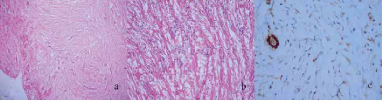 Figure 1. a) Dense, collagen rich, hyalinized, stroma with interspersed spindle-like cells and inflamatory cells (Haemotoxylin&amp;Eosin (HE) x40), b) Dense, collagen  rich, hyalinized, stroma with interspersed spindle-like cells and inflamatory cells (HEx