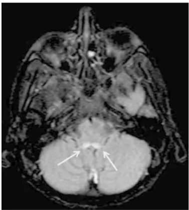 Figure 1a.  Axial  fluid-attenuated  inversion  recovery  magnetic  resonance imaging images of the brain demonstrating the  increased signal around the aqueductus sylvii.