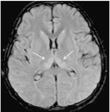 Figure 2b. Control magnetic resonance imaging 2 weeks after  the onset of the symptoms; fluid-attenuated inversion recovery  image showing the diminution of increased signal at the medial  parts of both thalami