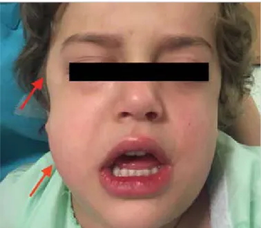 Figure 1. Swelling that postoperatively occurred on the right side of the  patient’s face (arrows)