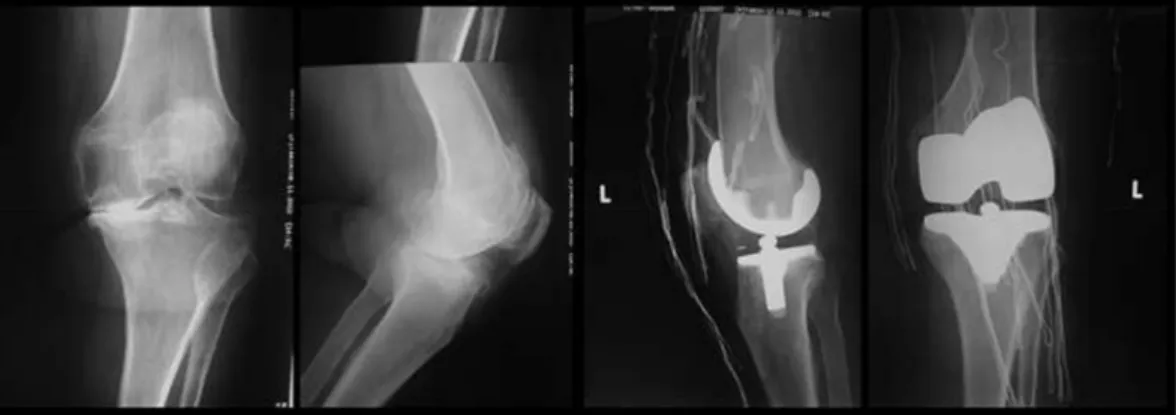 Fig. 1. Preoperative and postoperative radiographs of the left knee.