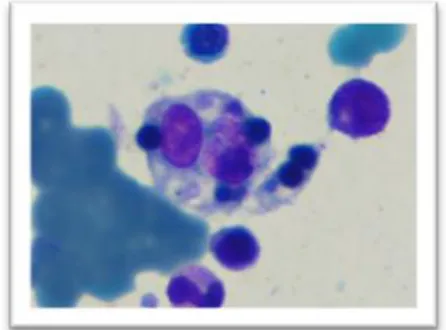 Figure  1.  Bone  marrow  cells  were  engulfed  by  histiocyte cell of bone marrow . 