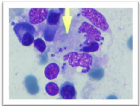 Figure 2. Amastigotes of Leishmania were engulfed  by histiocyte cell in bone marrow. 