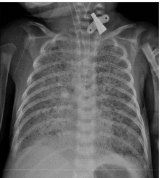 Fig.  1.  Chest  radiography  showed  a  diffuse  granular  pattern  compatible  with  severe  RDS
