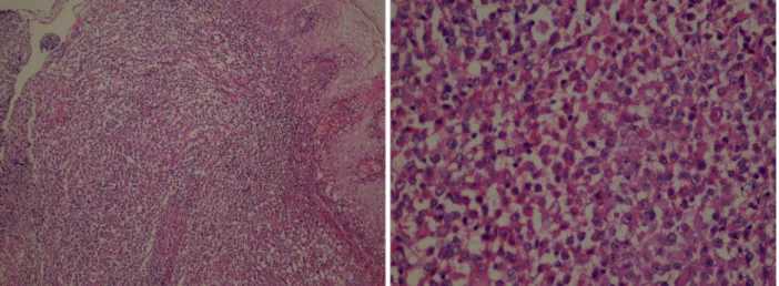 Fig. 3 CD1a staining of the sinusoidal LCH cells are demonstrated (immunoperoxidase, CD1a X200)
