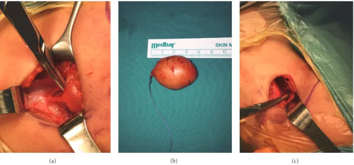 Figure 2: (a) Intraoperative view of the neurogenic mass. (b) The lesion with 4 cm size after the total excision