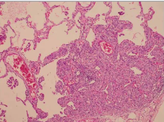Figure 2. Subpleural nodule in the parenchyma of the lungs 
