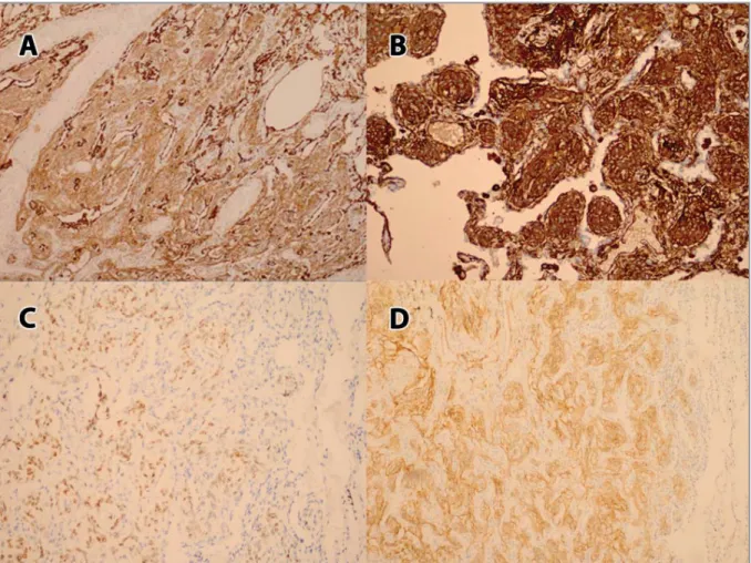 Figure 3. (A) Immunohistochemical staining was positive for meningothelial cells for EMA, (B) Vimentin, (C) Progesteron receptor,  (D) CD56
