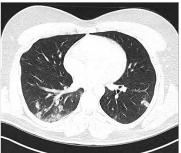 Figure 1. Thorax tomography image of a patient diagnosed with  