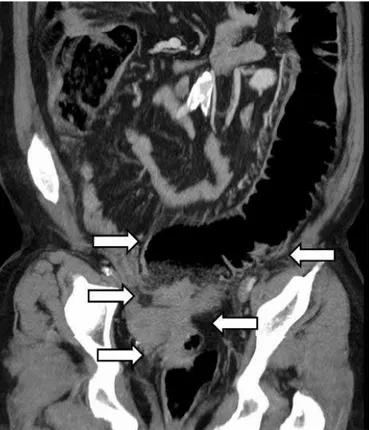 Figure 1. Reconstructed coronal computed tomography image showing  diffuse, irregular rectal wall thickening and dilated proximal colon  seg-ments (arrows).