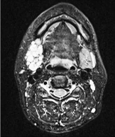 Figure 1. T2 axial MR images of tumor in the right submandibular  area resembling a potato sack