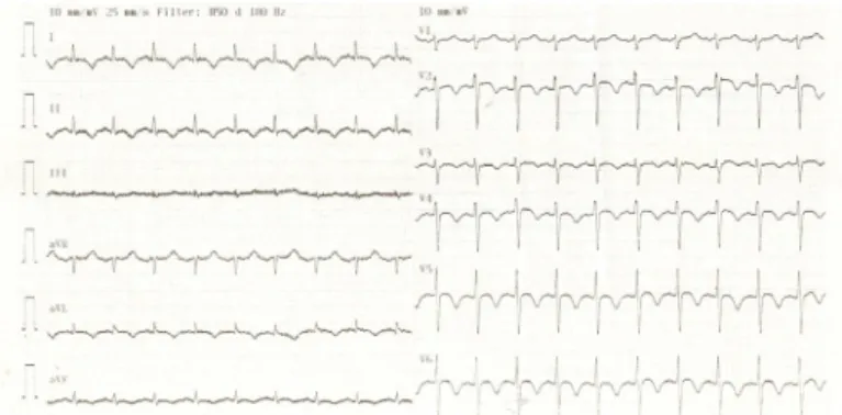 Figure 1. Electrocardiogram illustrate T wave inversion in precordial and  inferior leads