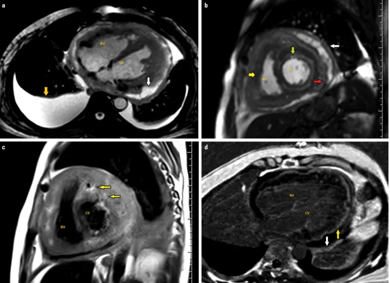 Figure 2. (a) Axial GE T2 weighted image shows pericardial [yellow arrow] and bilateral pleural [yellow arrow] effusion.