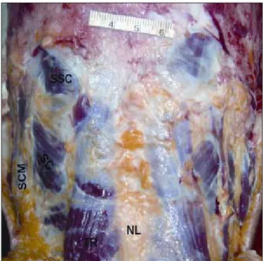 Figure 2: The superficial muscle layer photograph of a cadaveric  specimen (NL:  Nuchal ligament, SCM: sternocleidomastoid  muscle, SC: splenius capitus muscle, SSC: semispinalis capitus  muscle).