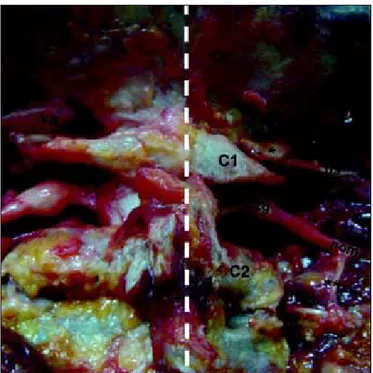Figure 9: A photograph of a cadaveric specimen (white-thick  dashed line: midline,  Oc:  occipital bone, va: vertebral artery,  C2g: C2 ganglion, ns: suboccipital nerve, single asterisks:  semi-canal for vertebral artery, noma:  major  occipital  nerve,  b