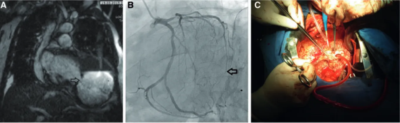 Figure 2: (A) Coronal and axial T2-weighted magnetic resonance images show a pseudoaneursym of the left ventricle