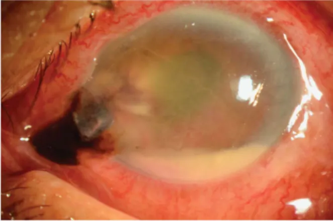 Figure 2A shows preoperative and postoperative photographs of a case with left type 1 Duane syndrome