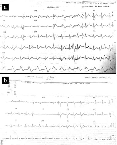 FIG. 2. a, b. Electrocardiography showed typical Brugada syndrome 