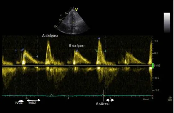 Şekil 2.2. Mitral giriş yolu PW Doppler Kaydı 