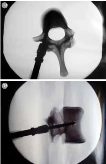 Fig. 1.  (a) Axial and (b) lateral view of the pedicle screw insertion  under fluoroscopic imaging.