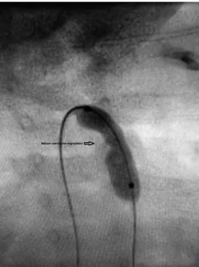 Figure 1. Discrete aortic coarctation in a premature 