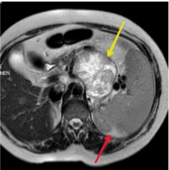 Fig. 2. Grossly characteristic brown appearence of the tumor. Tumor mass is well- well-surcumscribed with a ﬁbrous capsule.