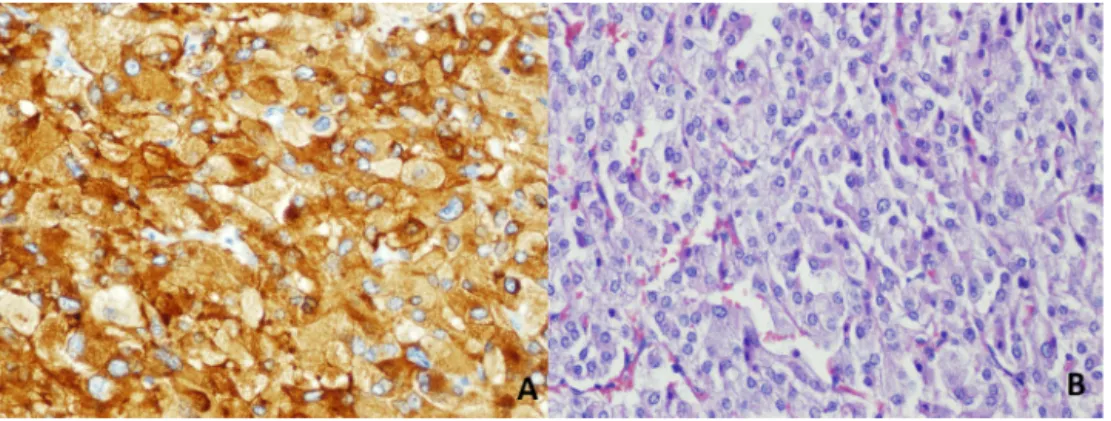 Fig. 3. (A): Chromogranin A: Tumor cells are diffusely positive for neuroendocrine marker Chromogranin A immunohistochemically