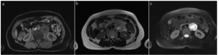 Figure 1. Axial magnetic resonance imaging images of the patient showing  well-defined spherical mass which is hypointense on T1-weighted imaging  (a), hyperintense with central cystic component on T2-weighted imaging (b)  and fat-saturated T2-weighted ima