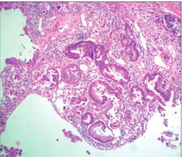 Figure 1: Mass forming invasive adenocarcinoma of gallbladder. Figure 2: Invasive adenocarcinoma of gallbladder (H&amp;e; x100).
