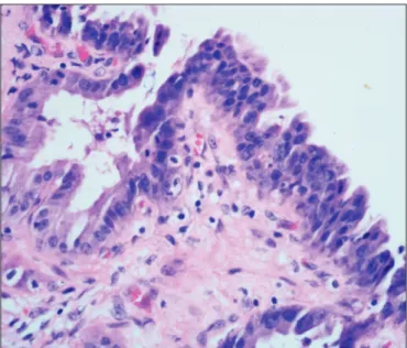 Figure 5: reactive atypia in gallbladder epithelium nearby 