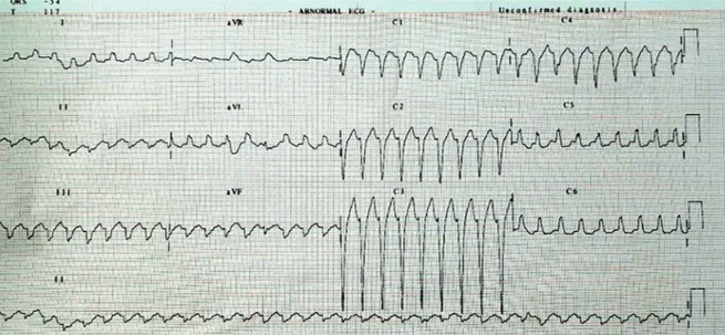 Fig. 1. Case 1: Electrocardiography at time of admission, wide QRS tachycardia with superior axis and left 