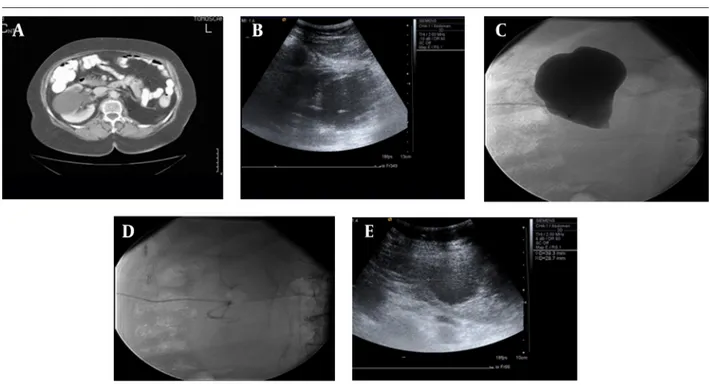 Figure 2. A 56-year-old man with Bosniak type-1 cyst in the right kidney with flank pain