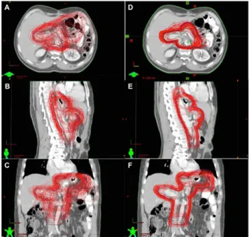 Figure 2. A representative image demonstrating planning target volumes (PTVs) delineated by course attendees and the reference (bold line) at (a) transverse, (b) sagittal and (c) coronal sections before the delineation course