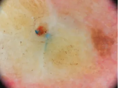 Figure 5. A Tzanck smear test reveals suture materials in a  foreign-body giant cell in a patient with a suture reaction  (May-Grünwald Giemsa 1000x)
