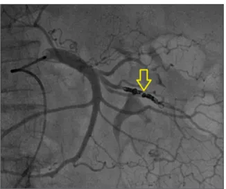 Figure 1.  Image of an aneurysm in the left branch of the superior 