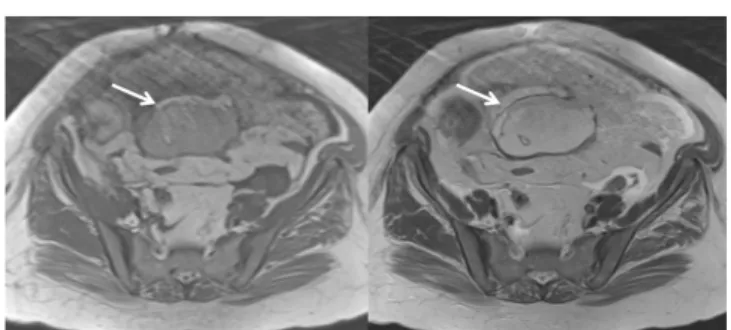 Figure 1. Precontrast and postcontrast axial computed tomography images show  intraperitoneal free fluid and ‘omental cake’ appearance.