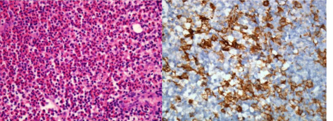 Figure 3: The histopathological images: fibrous tissue infiltrated with pleomorphic numerous eosinophils, histiocytic cells, polymorphonuclear leucocytes, lymphocytes,  few plasma cells and Langerhans cells  with strongly positive for S100 protein and CD1a