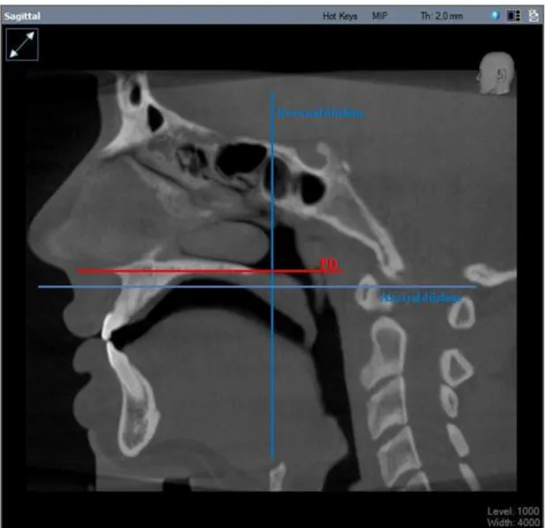 Şekil 3.2. Sagittal kesit üzerinde aksiyel, koronal ve palatinal düzlemin görüntüsü 